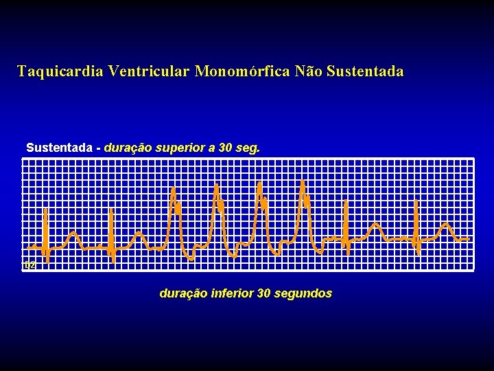 Taquicardia Ventricular Monomórfica Não Sustentada - duração superior a 30 seg. D 2 duração