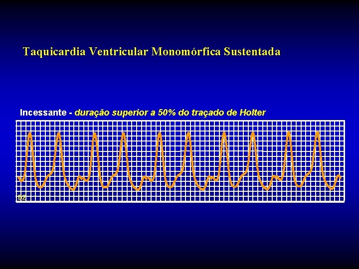 Taquicardia Ventricular Monomórfica Sustentada Incessante - duração superior a 50% do traçado de Holter Taquicardia Ventricular Monomórfica Sustentada Incessante - duração superior a 50% do traçado de Holter
