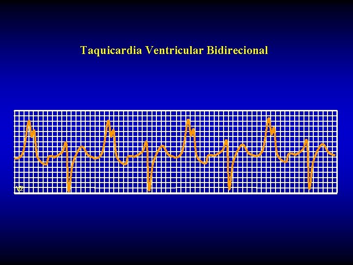 Taquicardia Ventricular Bidirecional V 2 