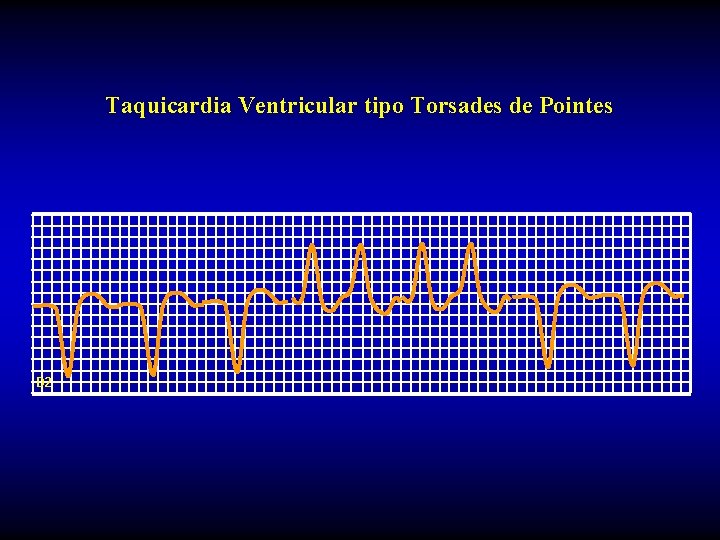 Taquicardia Ventricular tipo Torsades de Pointes D 2 Taquicardia Ventricular tipo Torsades de Pointes D 2