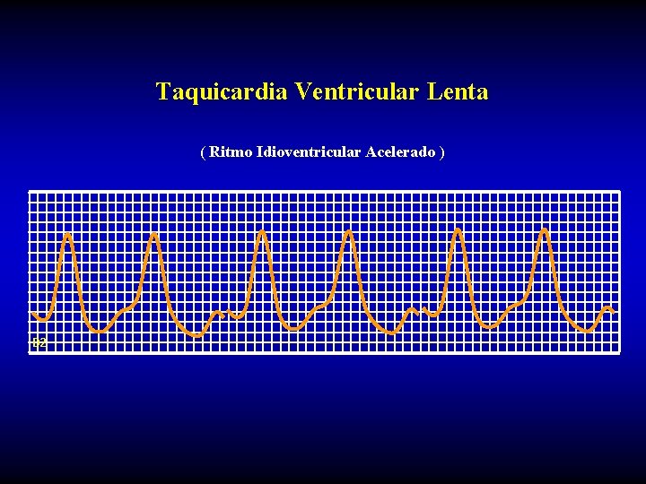 Taquicardia Ventricular Lenta ( Ritmo Idioventricular Acelerado ) D 2 