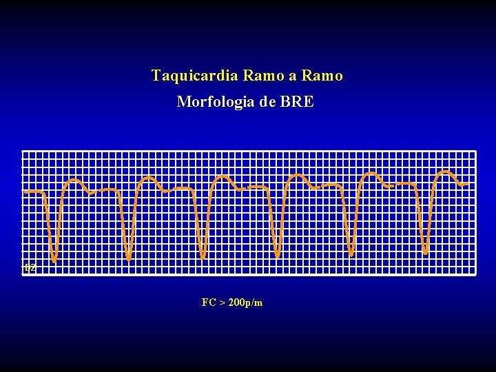 Taquicardia Ramo Morfologia de BRE D 2 FC > 200 p/m Taquicardia Ramo Morfologia de BRE D 2 FC > 200 p/m
