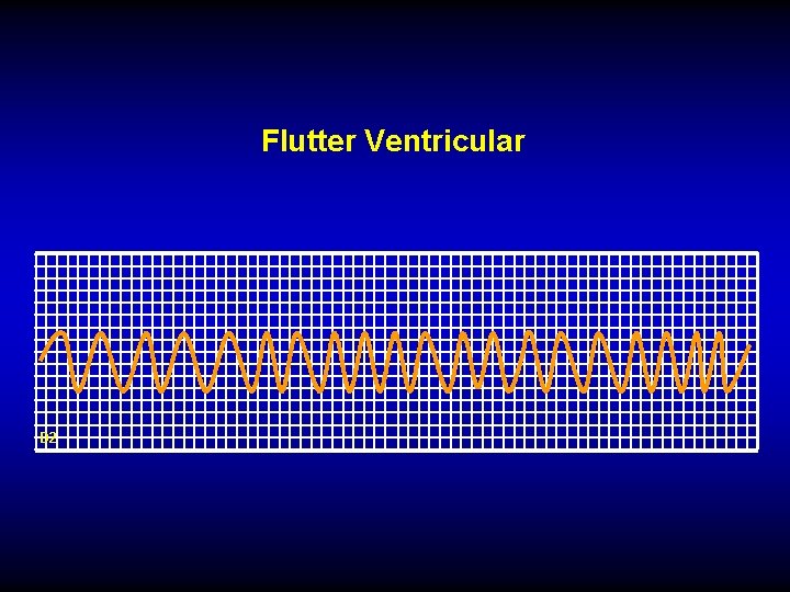 Flutter Ventricular D 2 