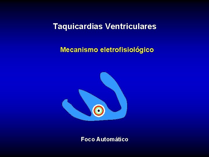 Taquicardias Ventriculares Mecanismo eletrofisiológico Foco Automático 
