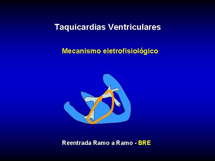 Taquicardias Ventriculares Mecanismo eletrofisiológico Reentrada Ramo - BRE 