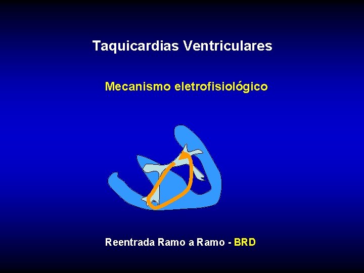 Taquicardias Ventriculares Mecanismo eletrofisiológico Reentrada Ramo - BRD 