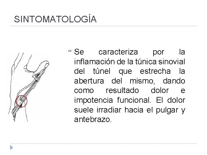 SINTOMATOLOGÍA Se caracteriza por la inflamación de la túnica sinovial del túnel que estrecha