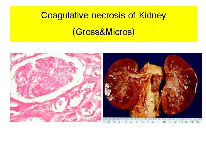 Coagulative necrosis of Kidney (Gross&Micros) 