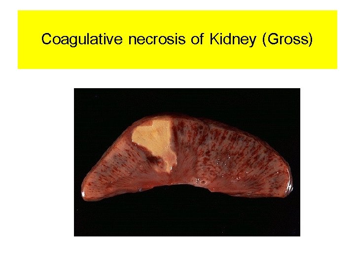 Coagulative necrosis of Kidney (Gross) 