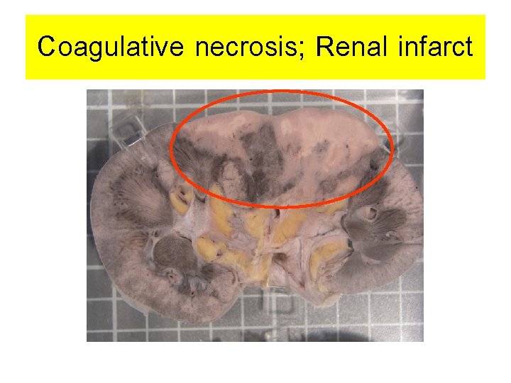 Coagulative necrosis; Renal infarct 