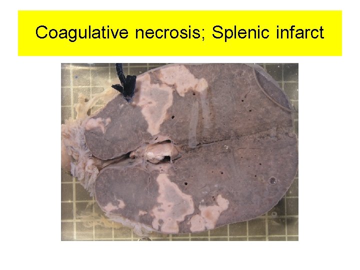 Coagulative necrosis; Splenic infarct 