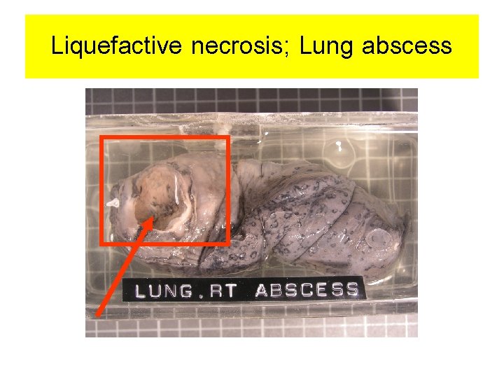 Liquefactive necrosis; Lung abscess 