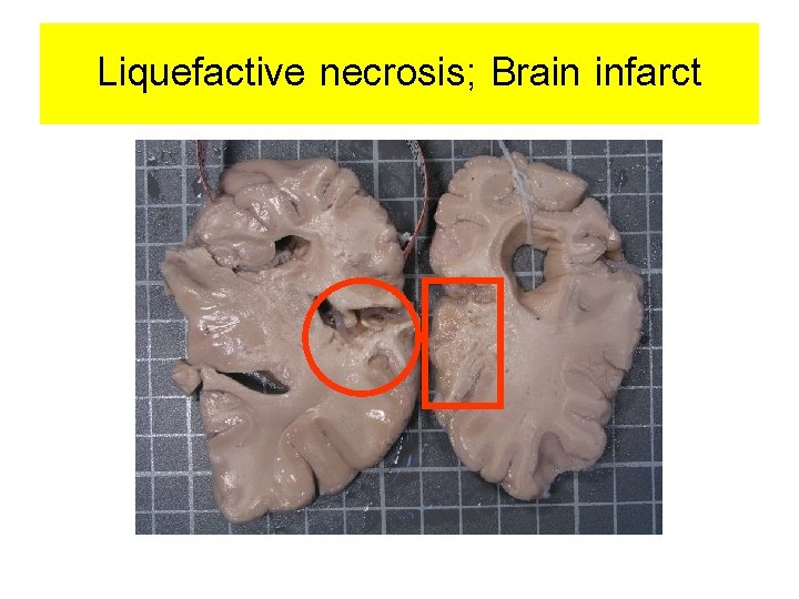 Liquefactive necrosis; Brain infarct 