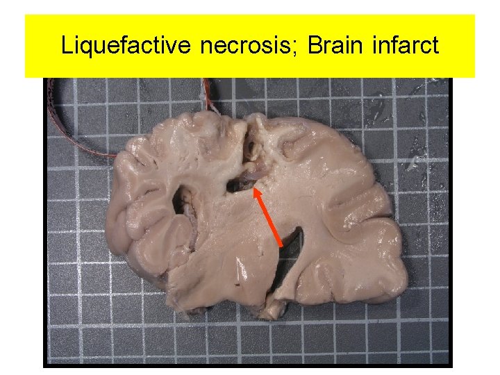 Liquefactive necrosis; Brain infarct 