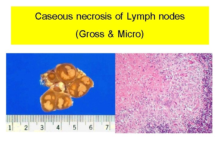 Caseous necrosis of Lymph nodes (Gross & Micro) 