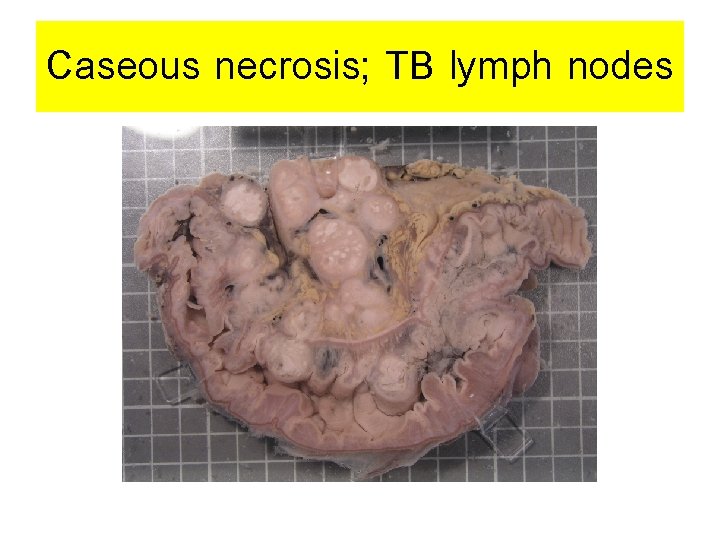 Caseous necrosis; TB lymph nodes 