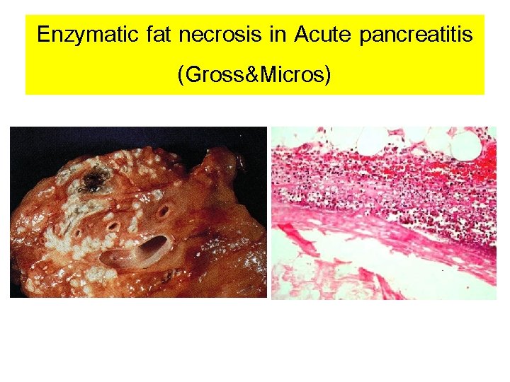 Enzymatic fat necrosis in Acute pancreatitis (Gross&Micros) 