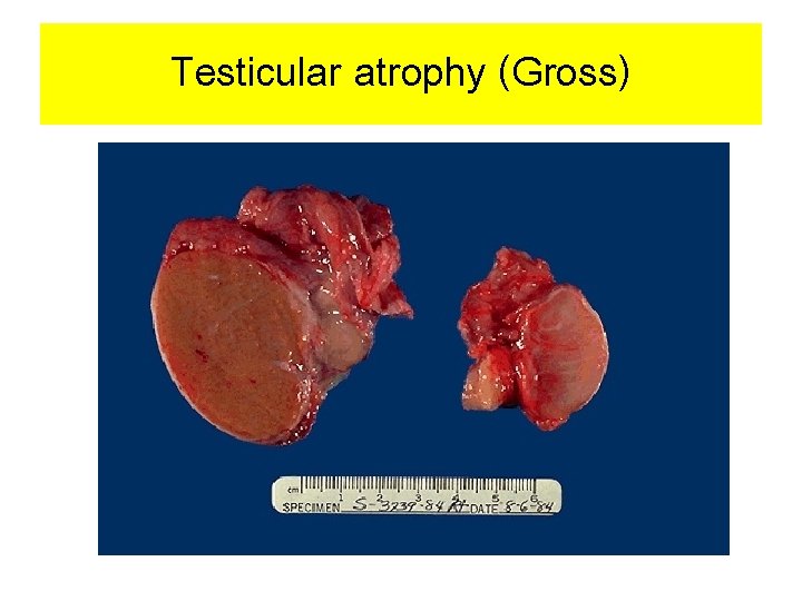Testicular atrophy (Gross) 