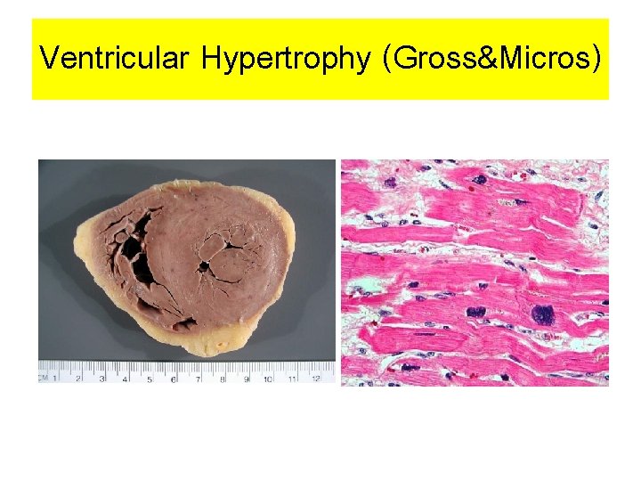 Ventricular Hypertrophy (Gross&Micros) 