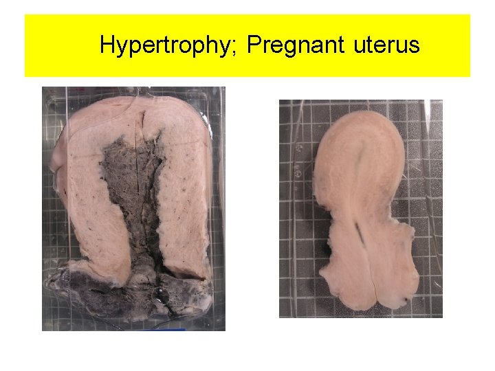 Hypertrophy; Pregnant uterus 
