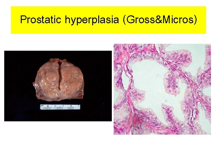 Prostatic hyperplasia (Gross&Micros) 