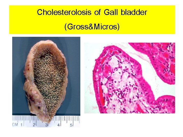 Cholesterolosis of Gall bladder (Gross&Micros) 