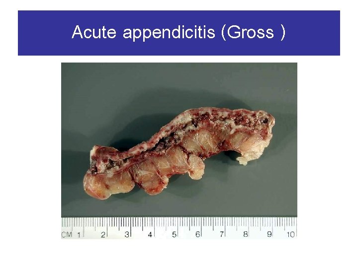 Acute appendicitis (Gross ) 