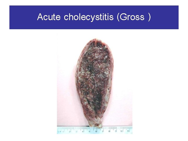 Acute cholecystitis (Gross ) 