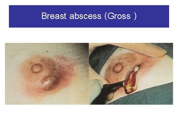 Breast abscess (Gross ) 