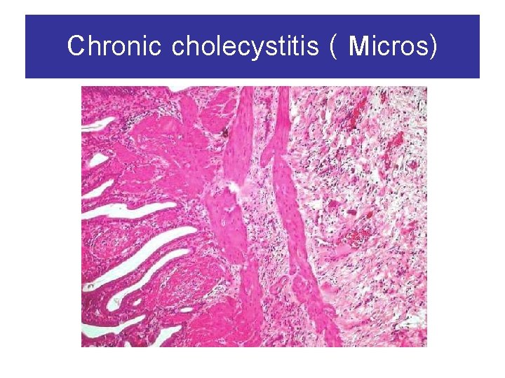 Chronic cholecystitis ( Micros) 
