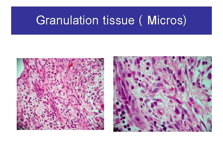 Granulation tissue ( Micros) 