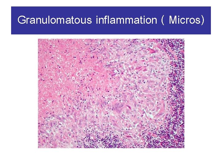 Granulomatous inflammation ( Micros) 