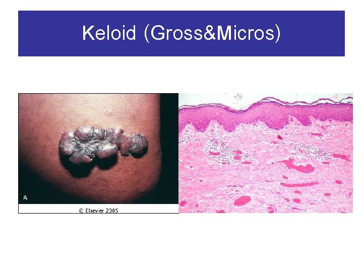 Keloid (Gross&Micros) 