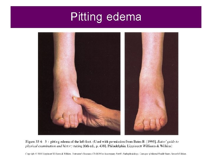Pitting edema 