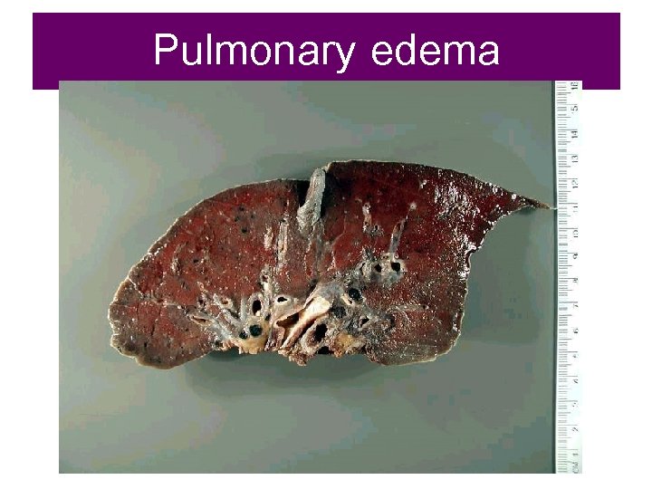 Pulmonary edema 