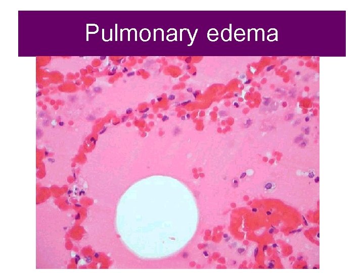 Pulmonary edema 