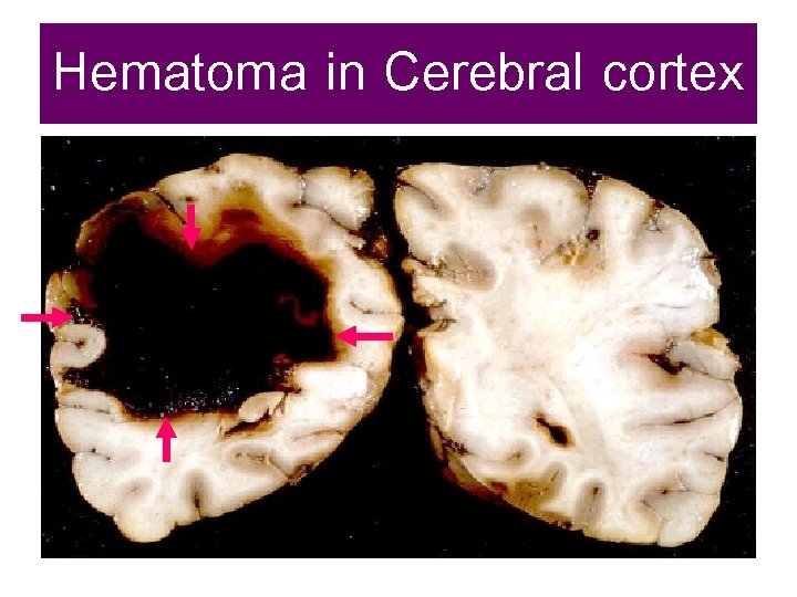 Hematoma in Cerebral cortex 