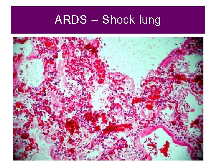 ARDS – Shock lung 