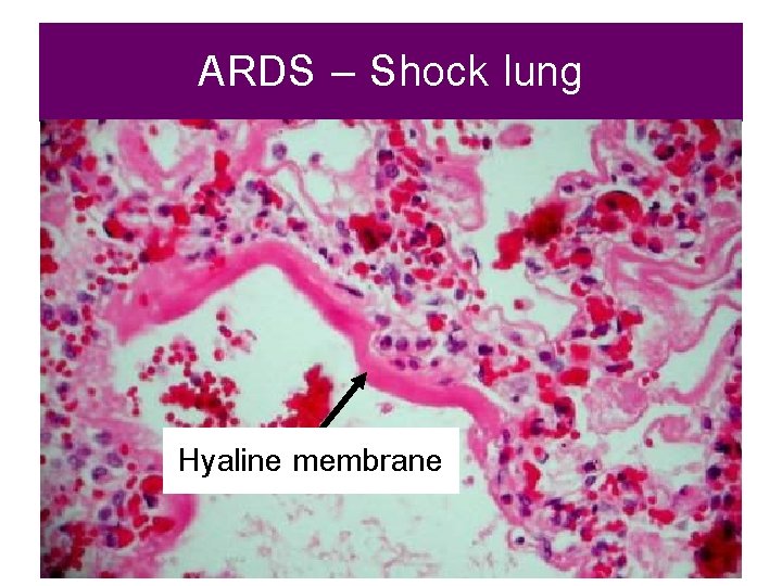 ARDS – Shock lung Hyaline membrane 
