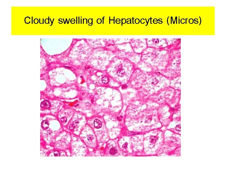 Cloudy swelling of Hepatocytes (Micros) 