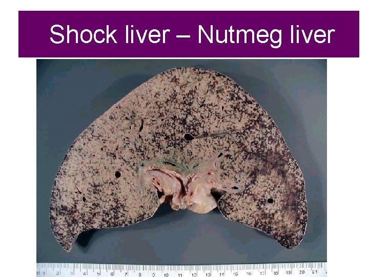 Shock liver – Nutmeg liver 