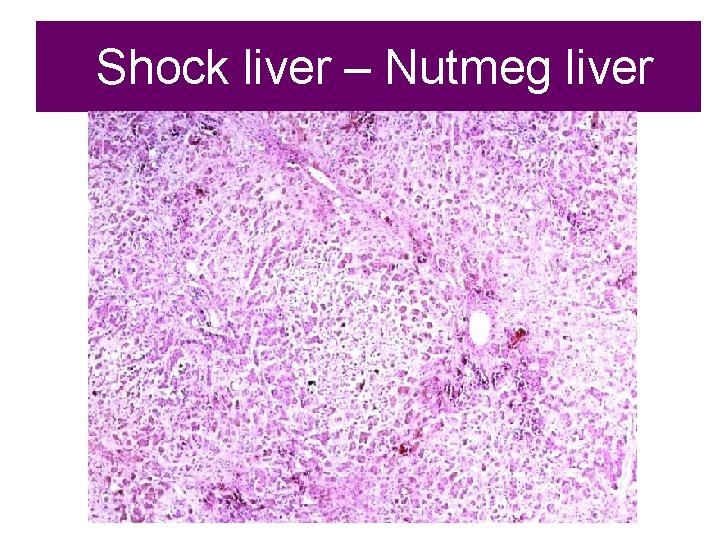 Shock liver – Nutmeg liver 