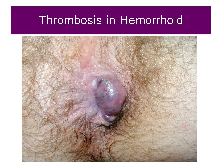 Thrombosis in Hemorrhoid 