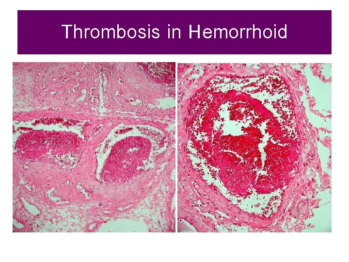 Thrombosis in Hemorrhoid 