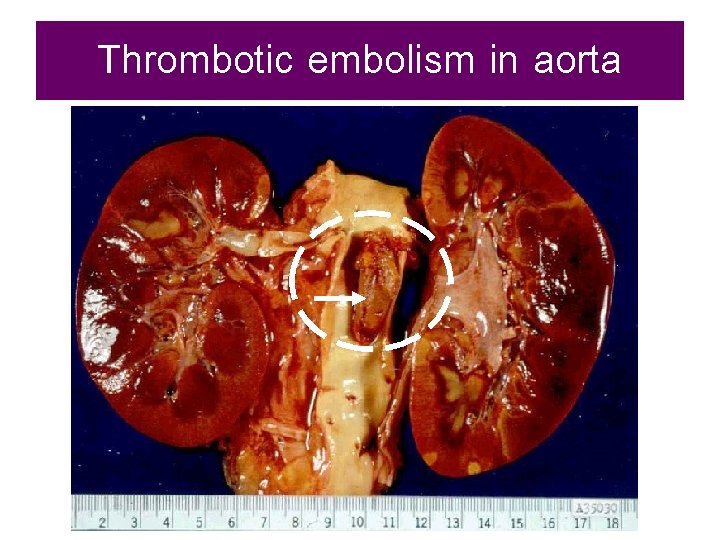Thrombotic embolism in aorta 