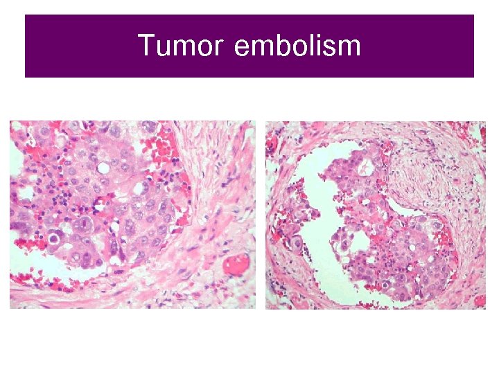 Tumor embolism 