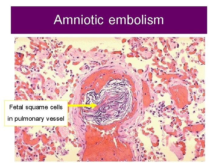 Amniotic embolism Fetal squame cells in pulmonary vessel 
