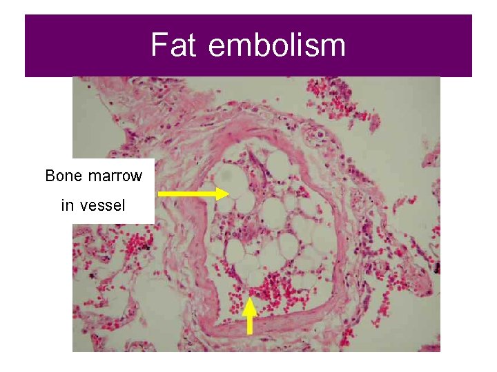 Fat embolism Bone marrow in vessel 