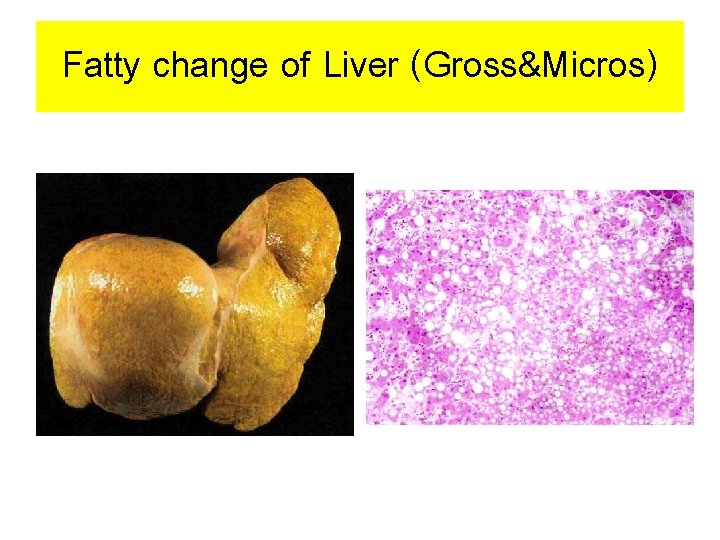 Fatty change of Liver (Gross&Micros) 