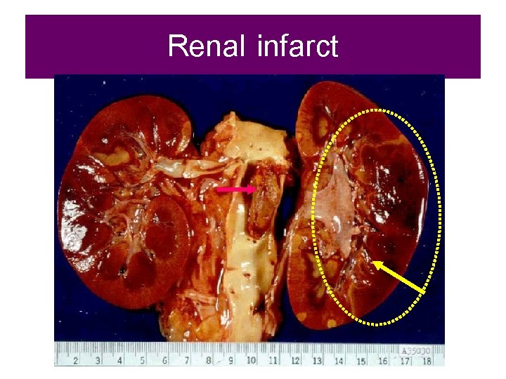 Renal infarct 